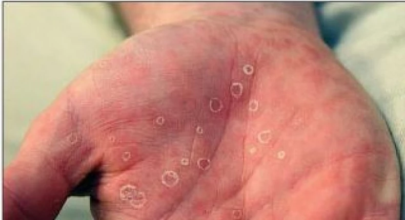 6 common s*xually transmitted diseases in Nigeria￼
