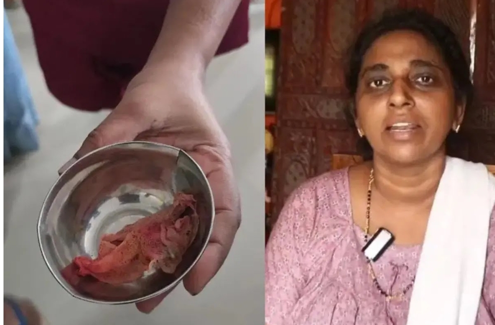 Surgeon’s cloth found inside woman’s abdomen three months after surgery