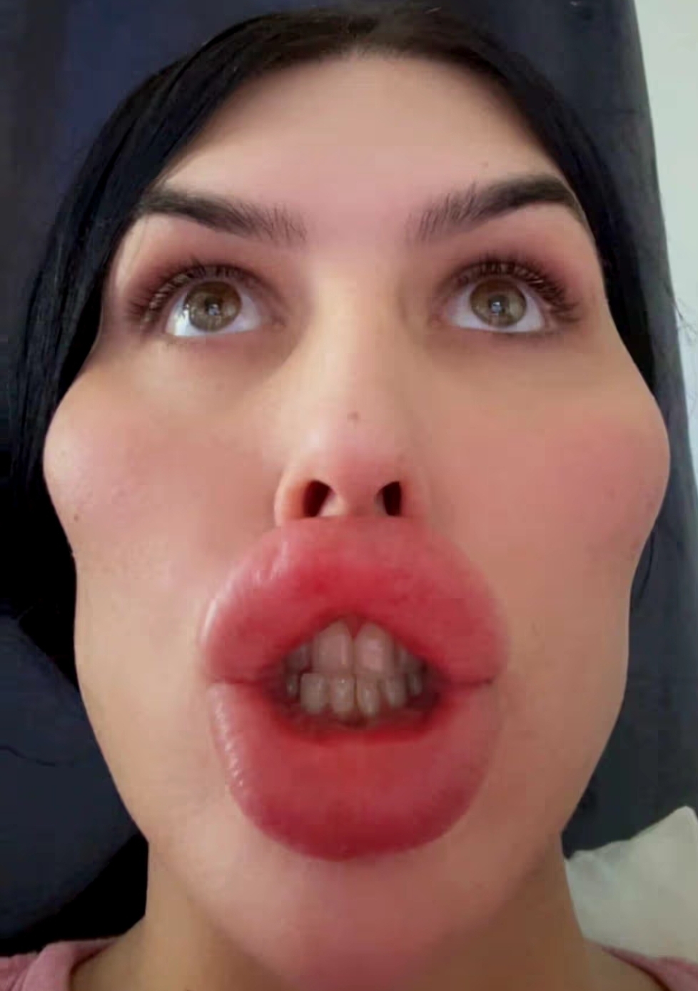 Woman with ‘UK’s biggest lips’ has lip fillers dissolved to show natural look