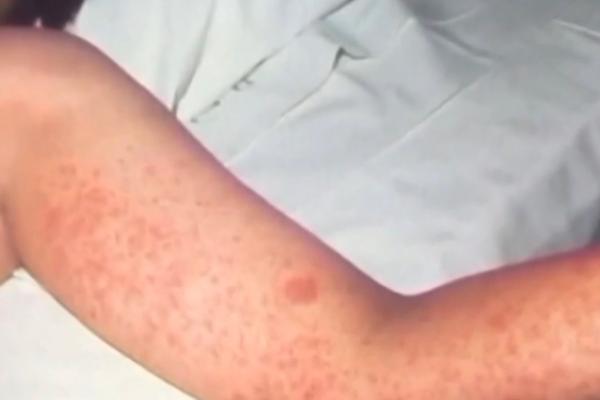 Measles spreading in California as cases hit 34