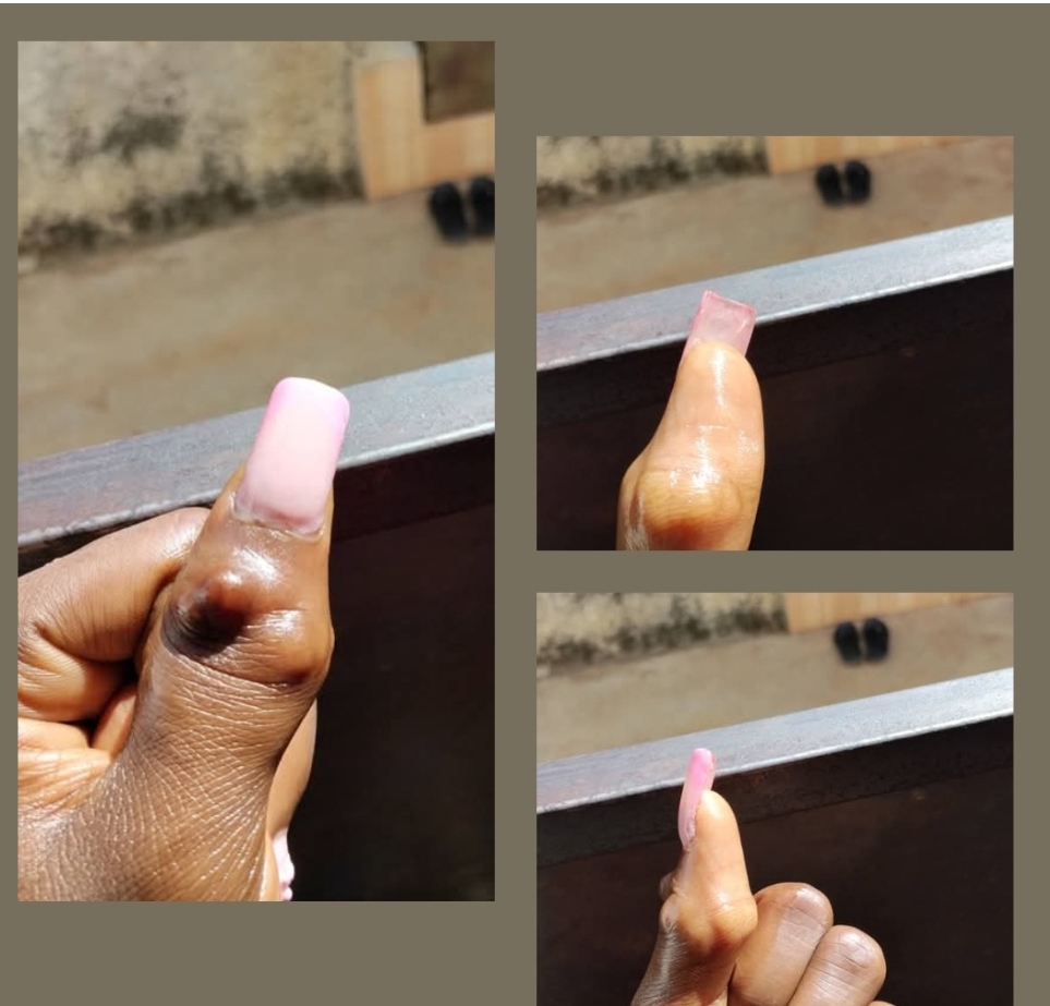Woman shows how she was disfigured by a senior  in secondary school