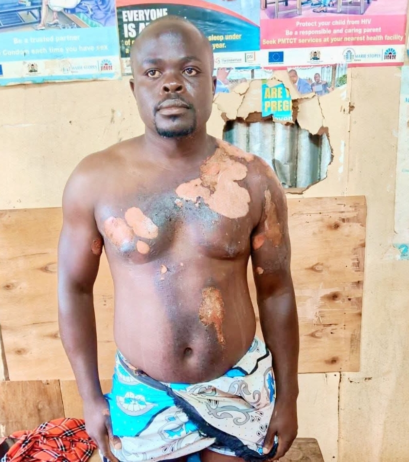 Kenyan woman attacks her husband with boiling water after he introduced his second wife