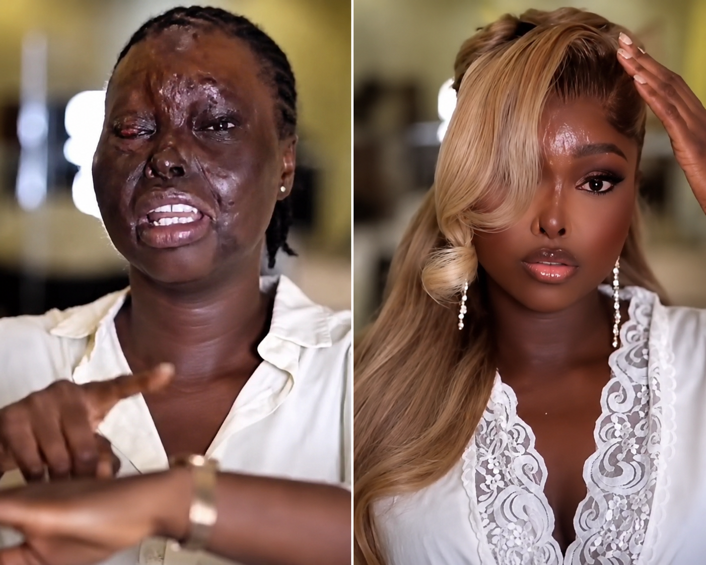 “I’m in the Era of Overcoming My Fear” – Acid Attack Survivor Stuns with Beauty Makeover
