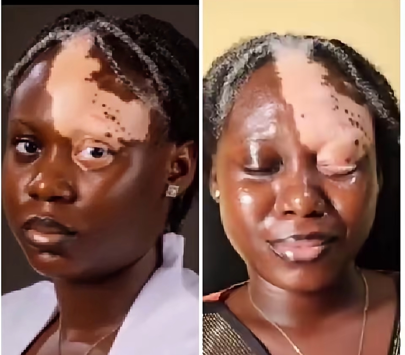 My Boyfriend Left Me After I Was Diagnosed With Vitiligo’ — Woman Shares Her Story